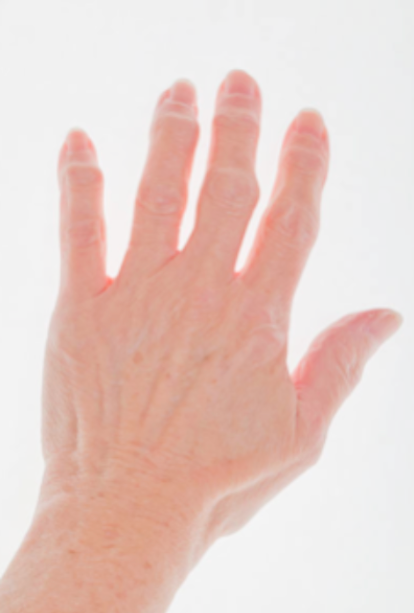 Molecular Hydrogen benefits Rheumatoid Arthritis and MUCH MORE